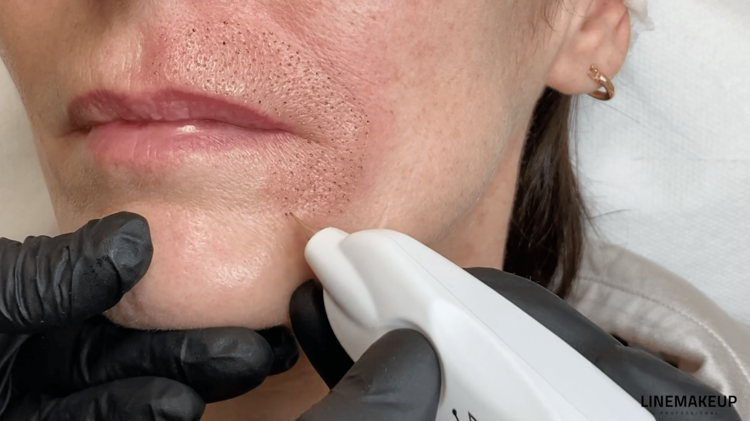 2_PL_FR_LE-PLASMA-LIFT-EN-REGION-LABIO-MENTONNIERE-SUR-MODELE