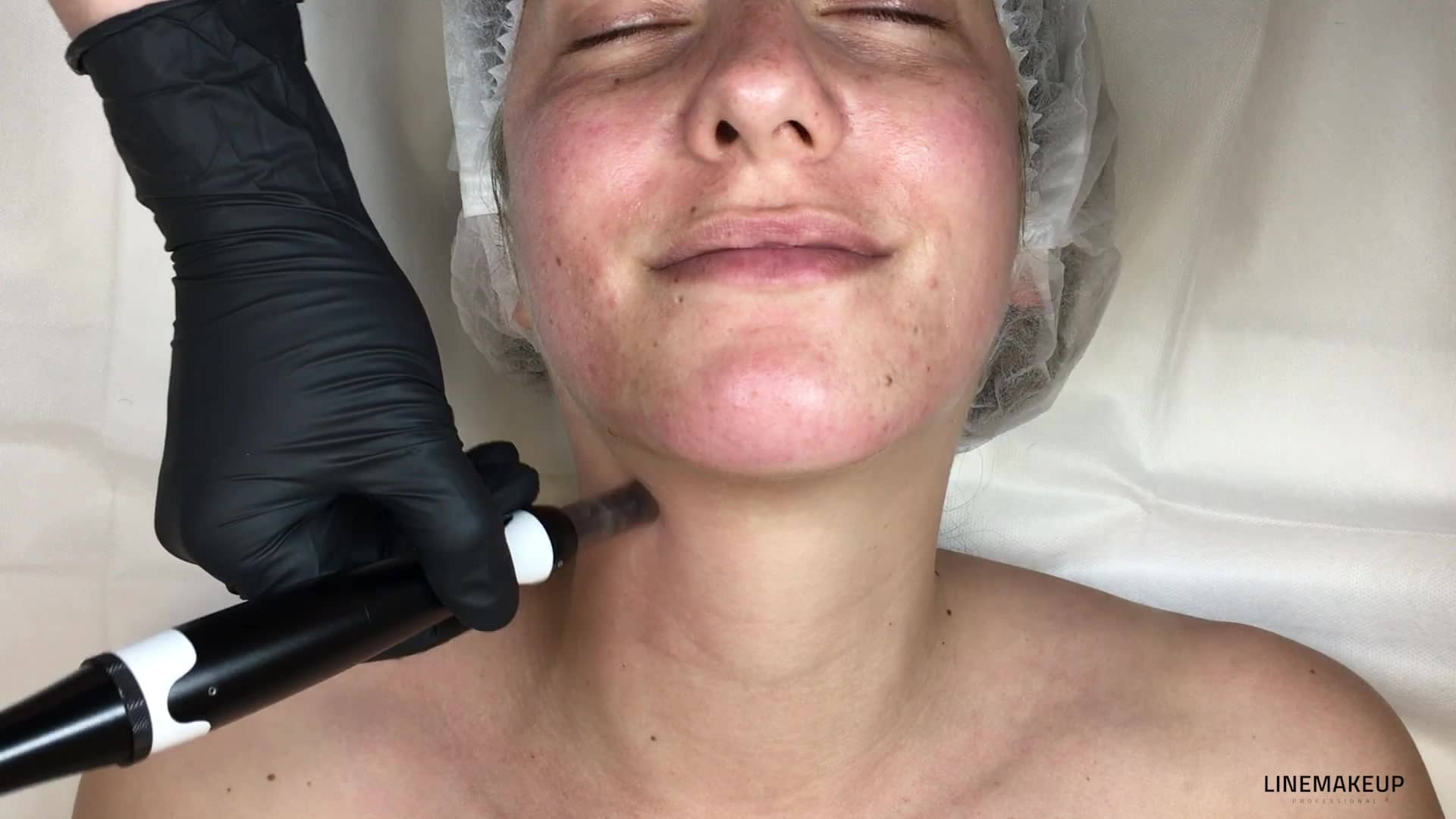 3.10_MN_FR_Le-Microneedling-sur-le-cou