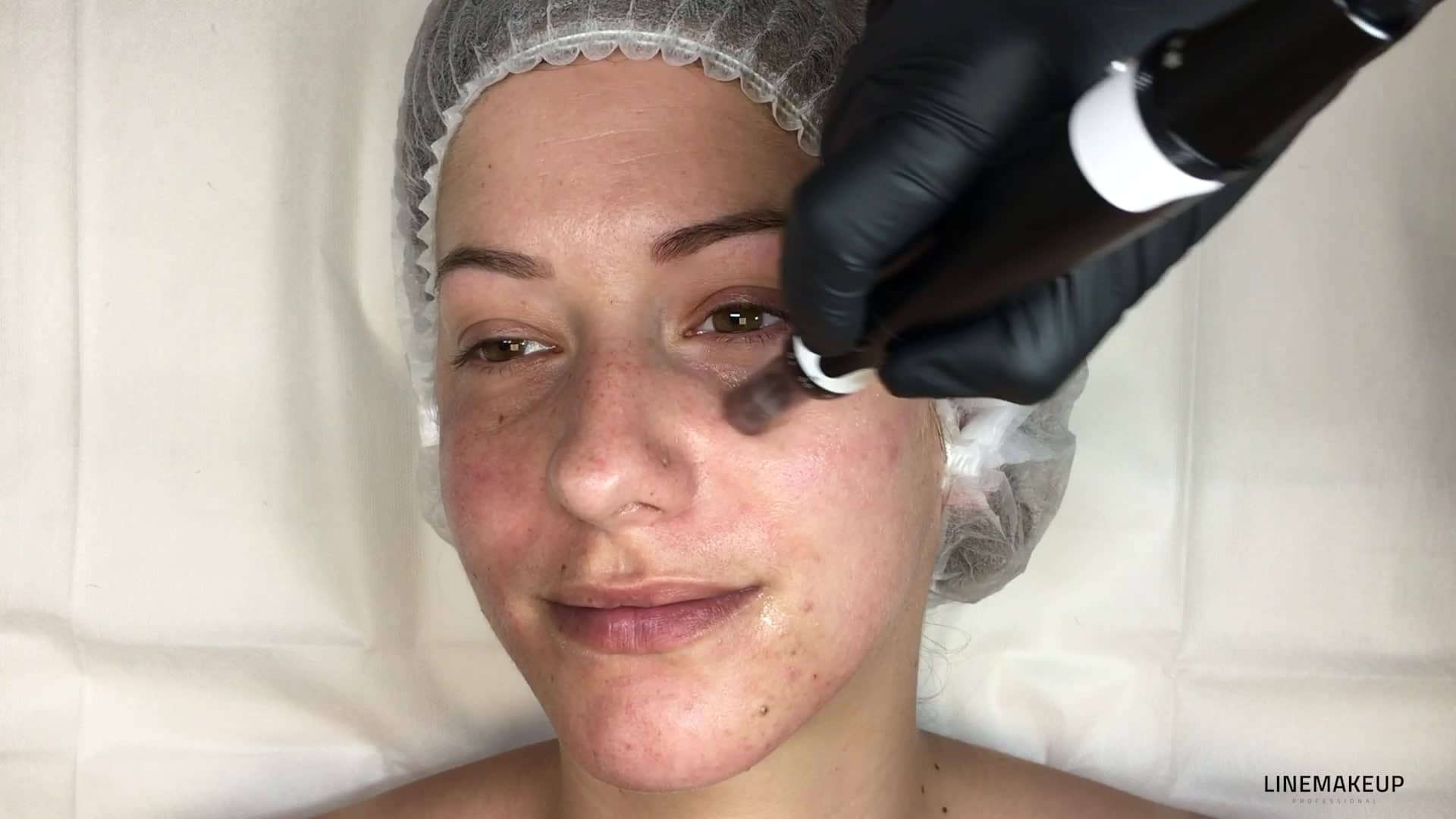 3.5_MN_FR_Le-Microneedling-au-niveau-du-contour-des-yeux