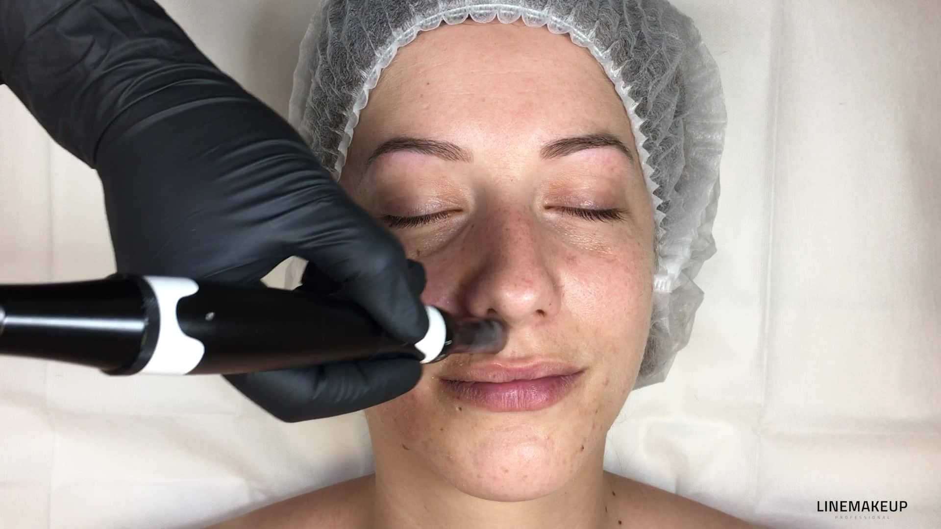 3.6_MN_FR_Le-Microneedling-sur-la-levre-superieure