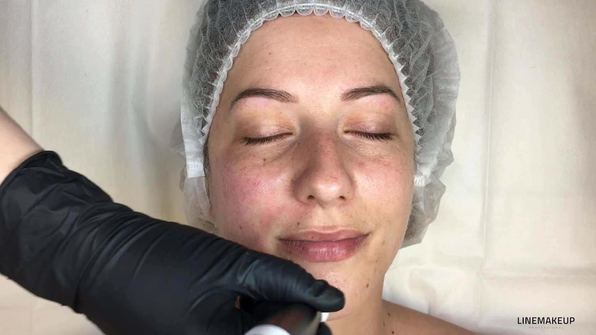 3.7_MN_FR_Le-Microneedling-sur-le-menton
