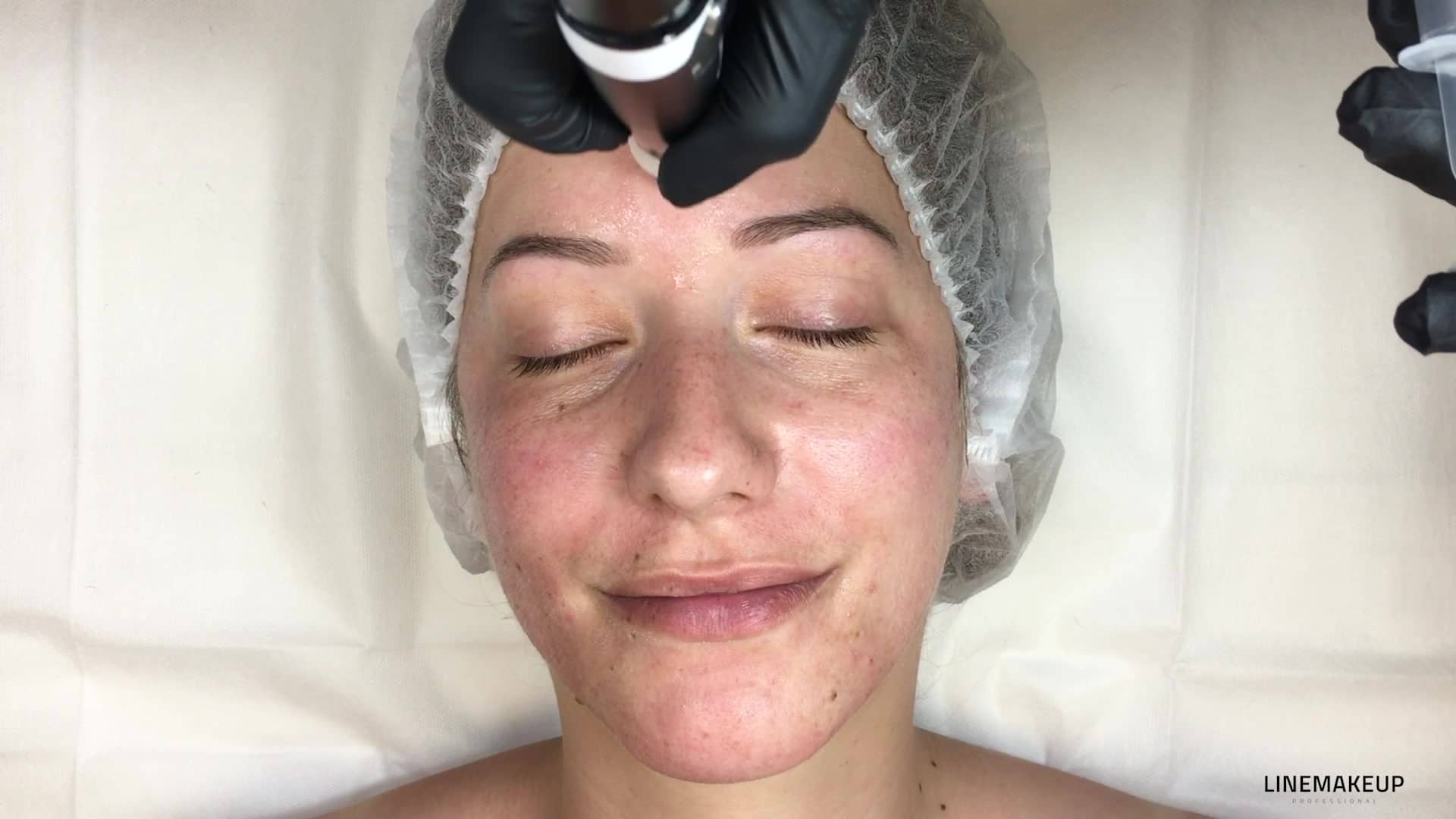 3.8_MN_FR_Le-Microneedling-sur-le-front
