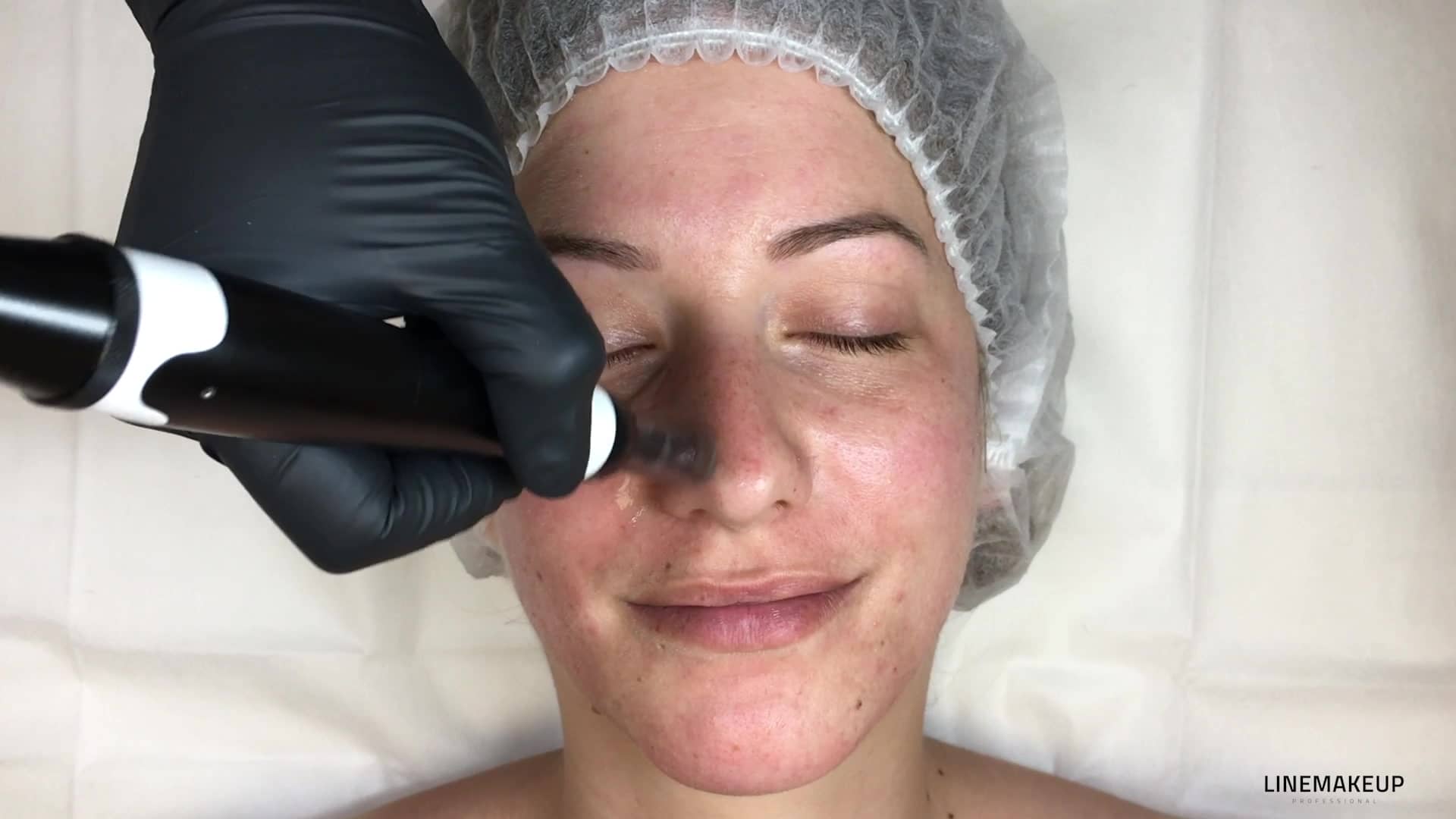 3.9_MN_FR_Le-Microneedling-sur-le-nez