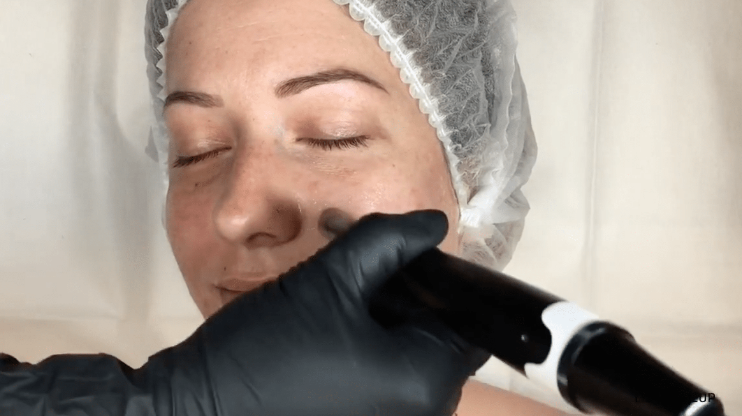 3_MN_FR_LE-MICRONEEDLING-SUR-MODELE