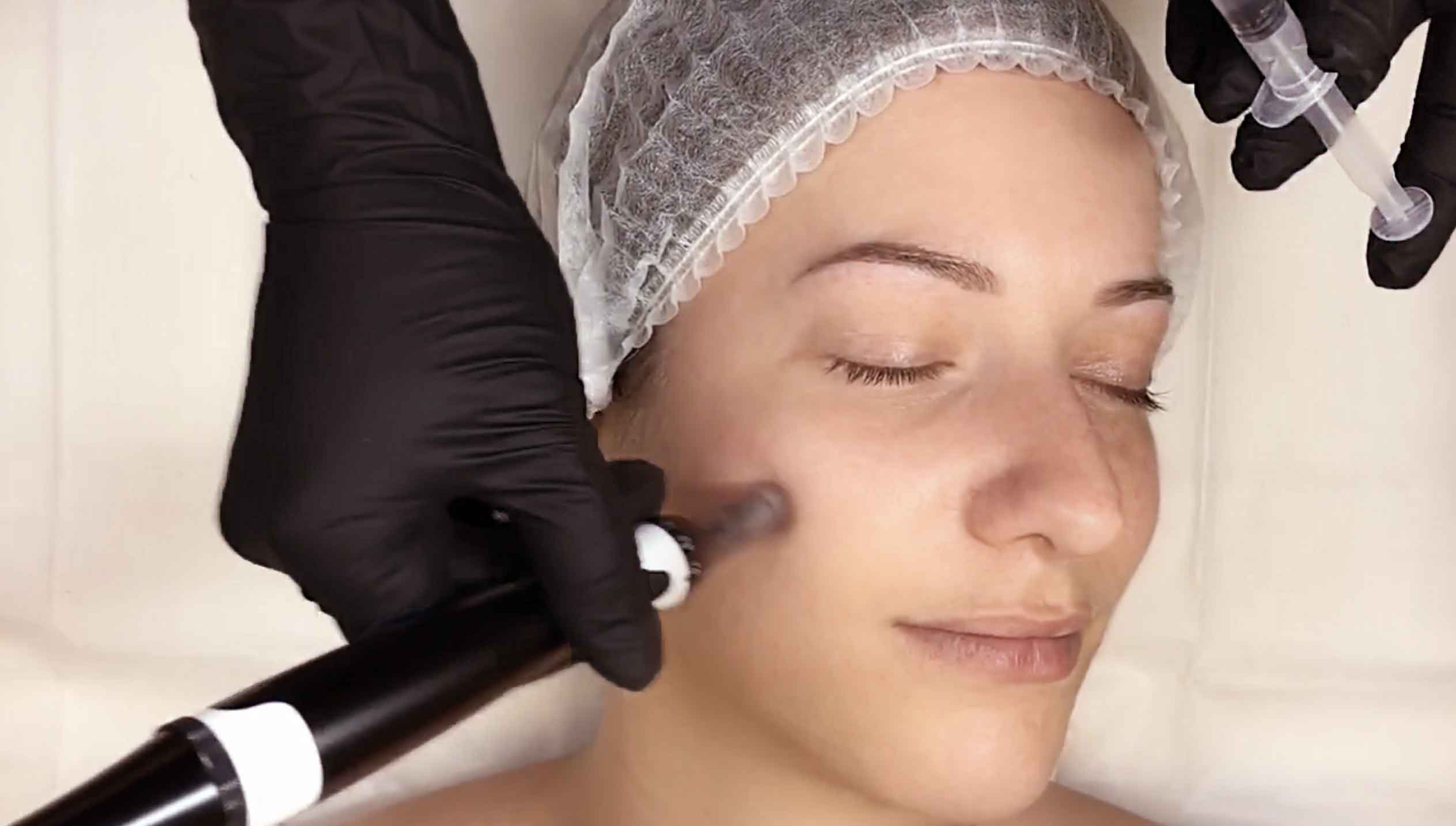 Formation Microneedling