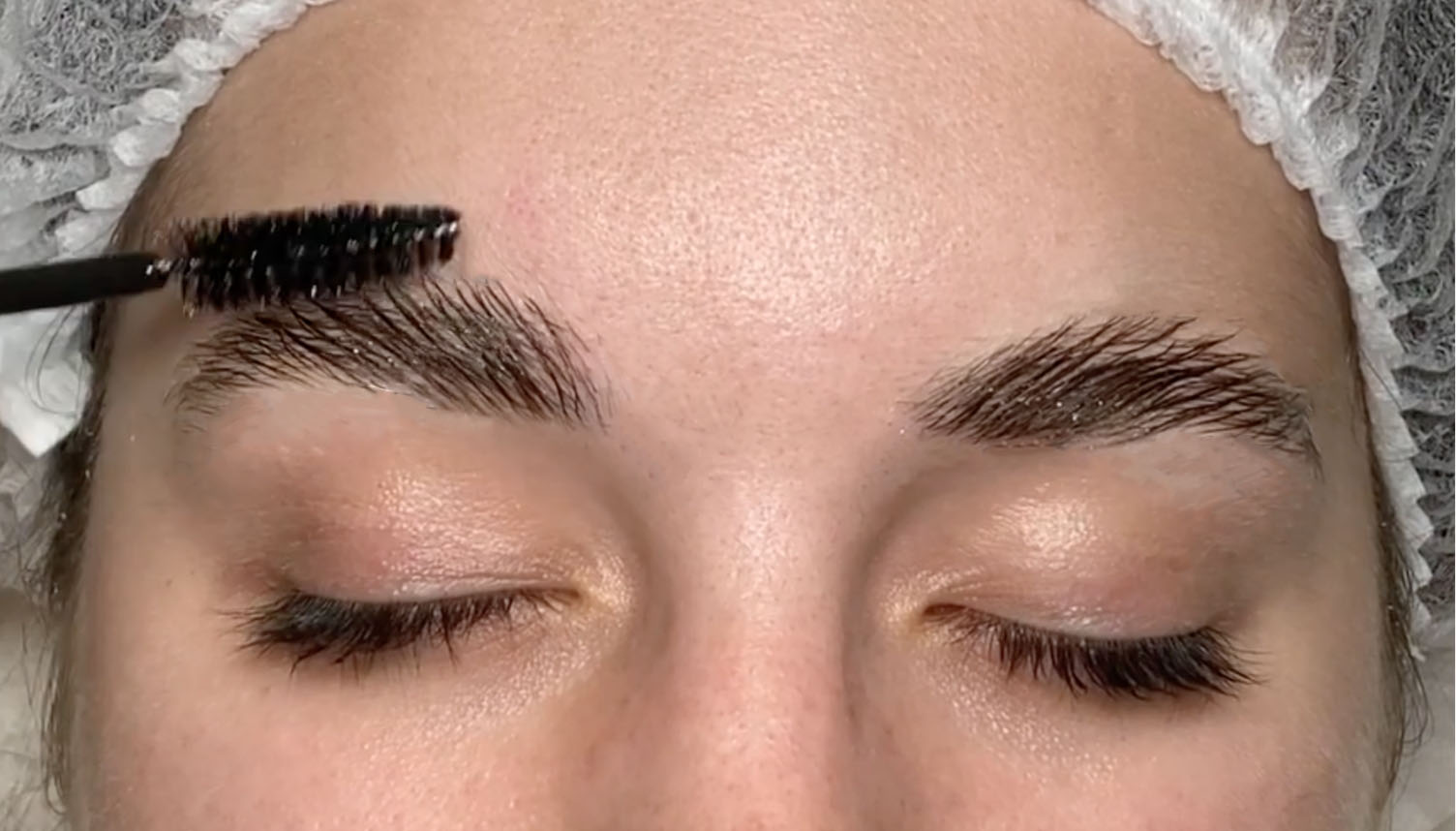 brow-lift