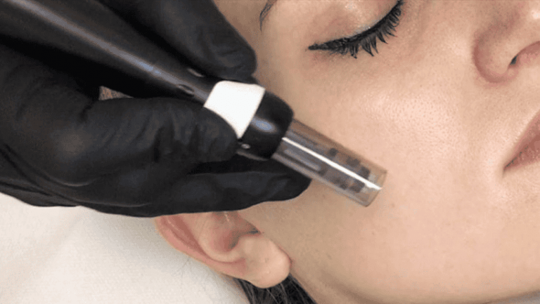 MICRONEEDLING