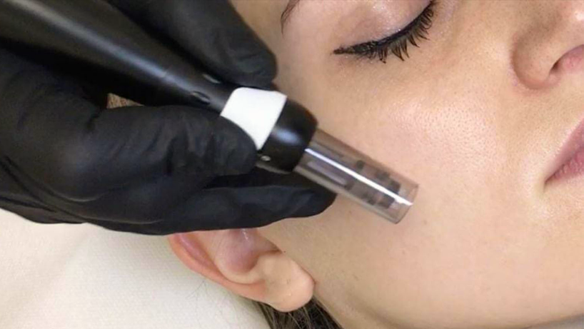 microneedling