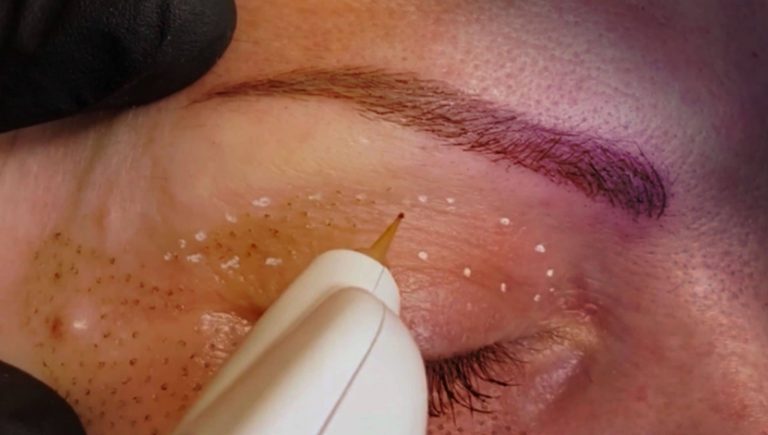 PLASMA LIFT